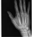 Broken Hand (264472)