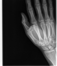 Broken Hand (264473)