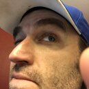 Blackhead Removal Experimentation (996096)