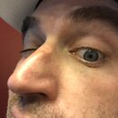 Blackhead Removal Experimentation (997088)