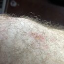 Forearm Poison Ivy Shots (994664)