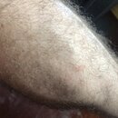 Forearm Poison Ivy Shots (995755)