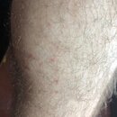 Forearm Poison Ivy Shots (995683)