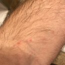 Forearm Poison Ivy Shots (993423)