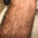 Forearm Poison Ivy Shots (996688)