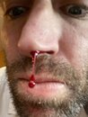 Inexplicable Bloody Nose (1000996)
