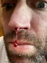Inexplicable Bloody Nose
