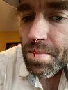 Inexplicable Bloody Nose (1002011)