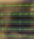 My Personal EKG (1167254)