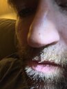 Examining my Nose Cancer (1209700)